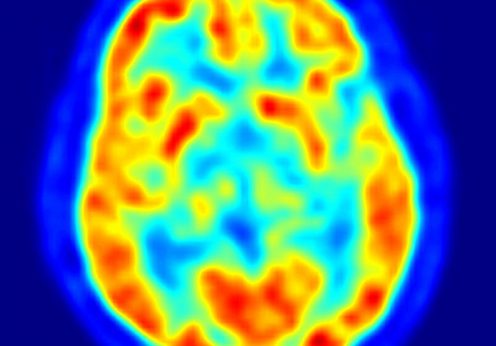 Vedere axiala a creierului la tomografie prin emisie de pozitroni.